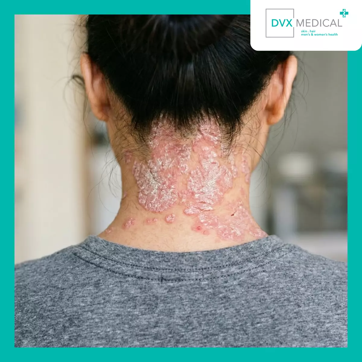 Tanda Apa yang Menunjukkan Psoriasis Mungkin Tidak Lagi Terkontrol?