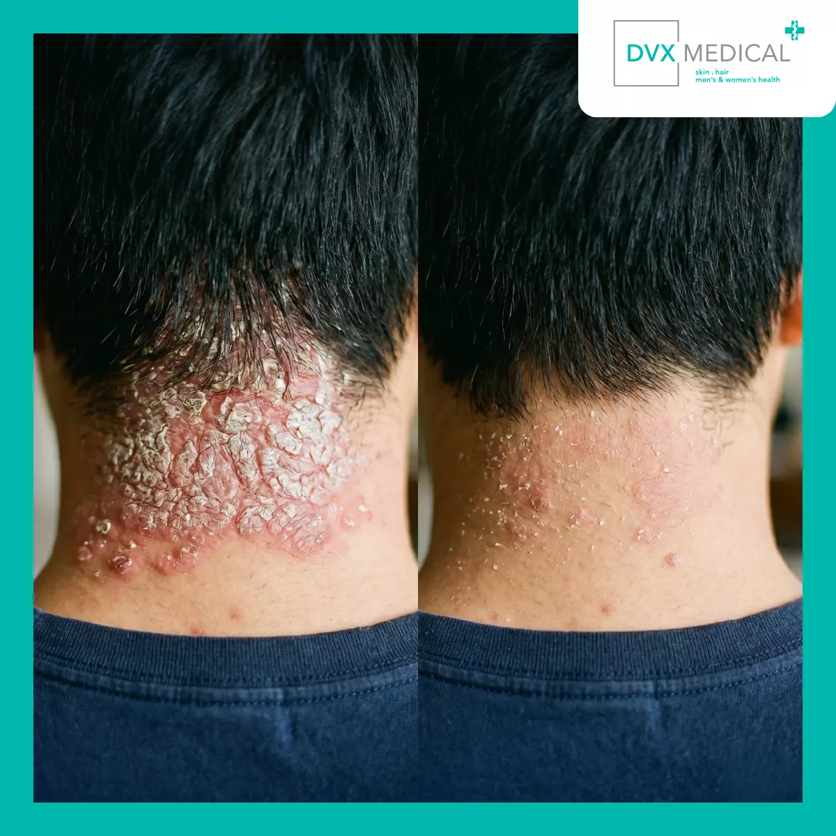Mengapa Psoriasis Berat Berbeda dari Psoriasis yang Lebih Ringan?