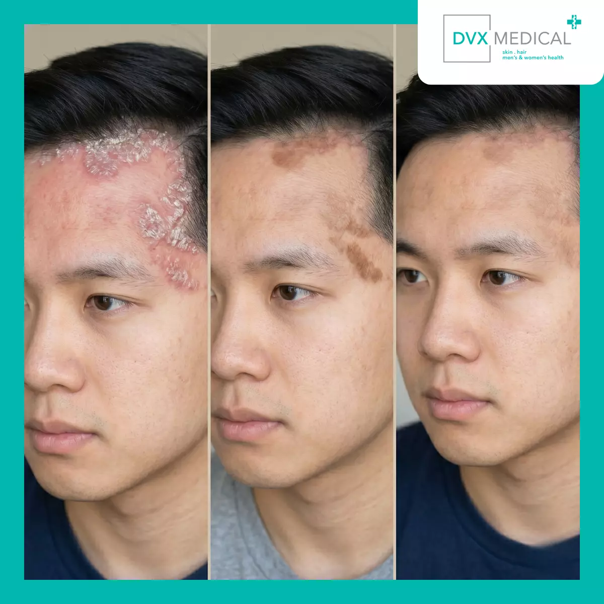 Apakah Kulit yang Sudah Membaik Berarti Psoriasis Sudah Hilang?