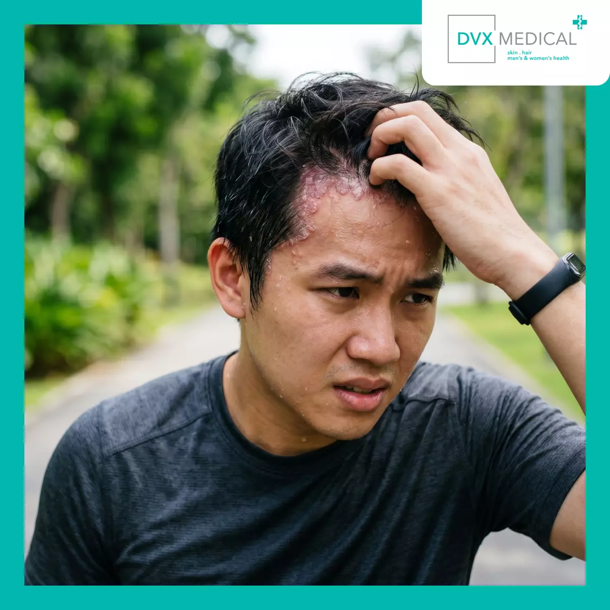 Apakah Psoriasis Benar-Benar Memburuk Secara Tiba-Tiba?