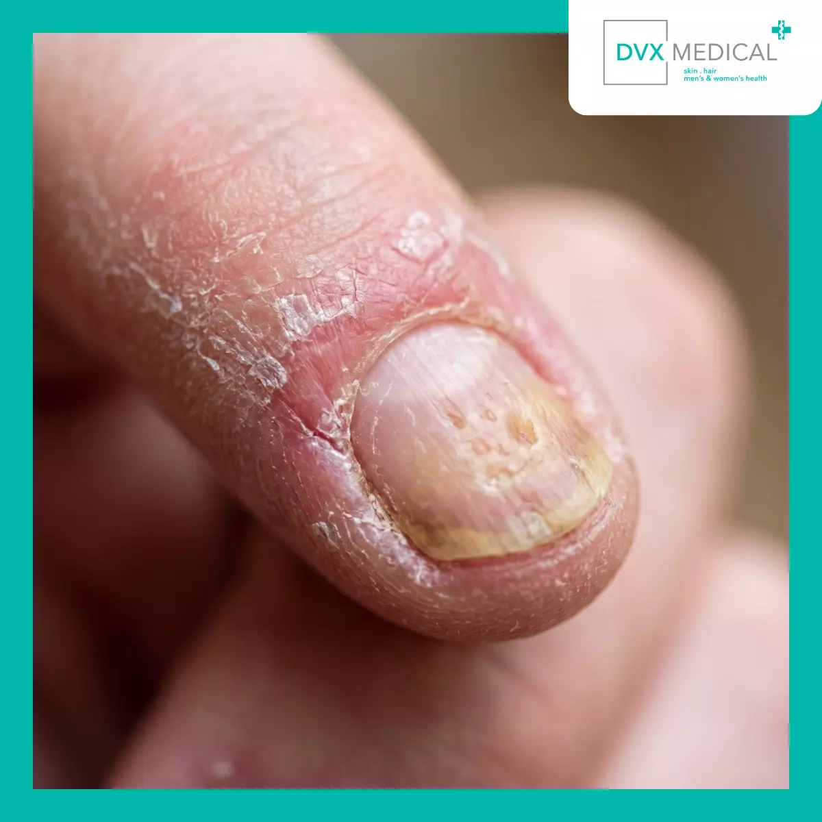 Perubahan Kuku Seperti Apa yang Dapat Terjadi pada Psoriasis?