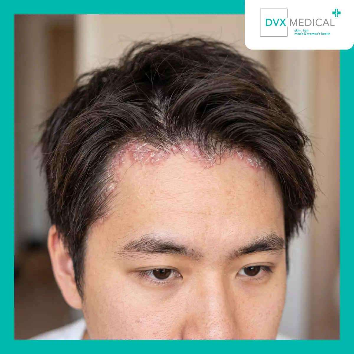 Mengapa Psoriasis Kulit Kepala Sering Disalahartikan?