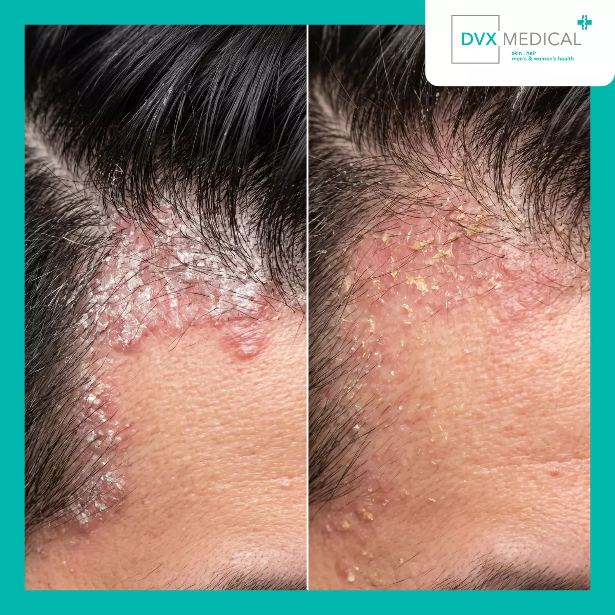Apa yang Membuat Psoriasis Berbeda dari Dermatitis Seboroik?