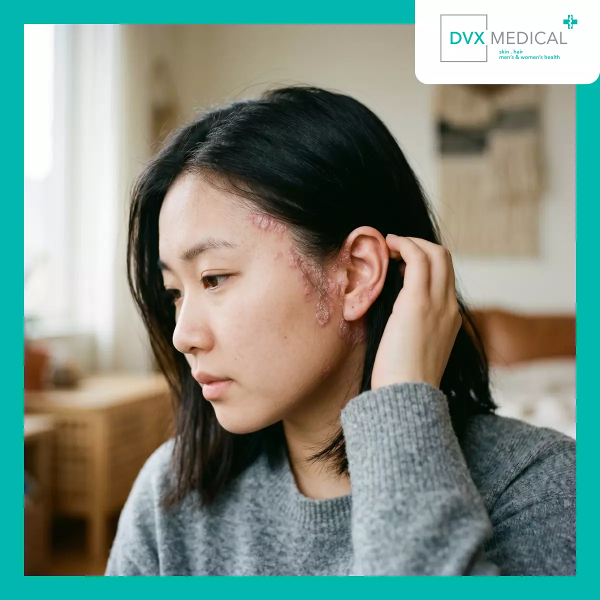 Mengapa Psoriasis Kulit Kepala Sering Lebih Sulit Diobati?