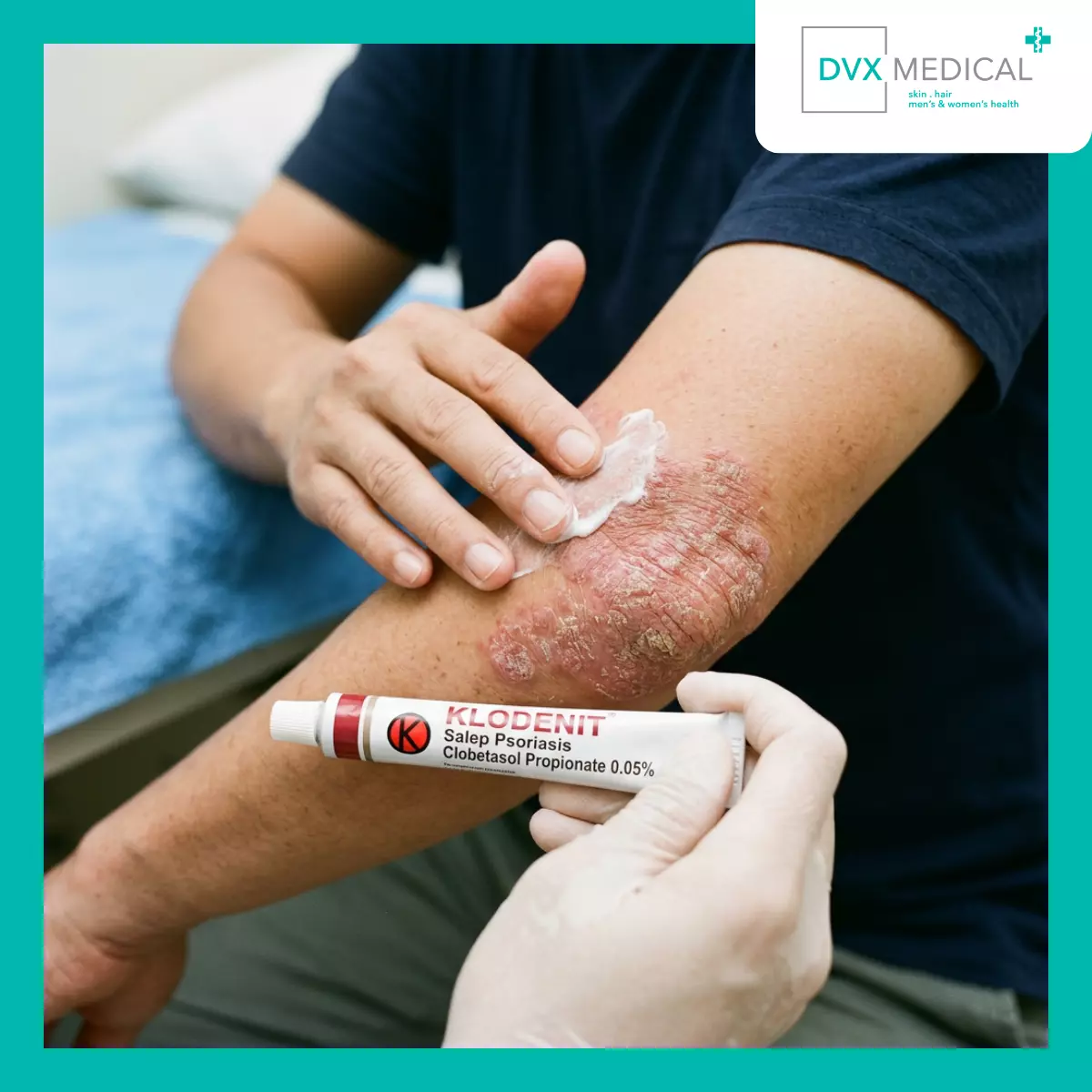 Mengapa Kortikosteroid Menjadi Salah Satu Pengobatan Psoriasis yang Paling Sering Digunakan?
