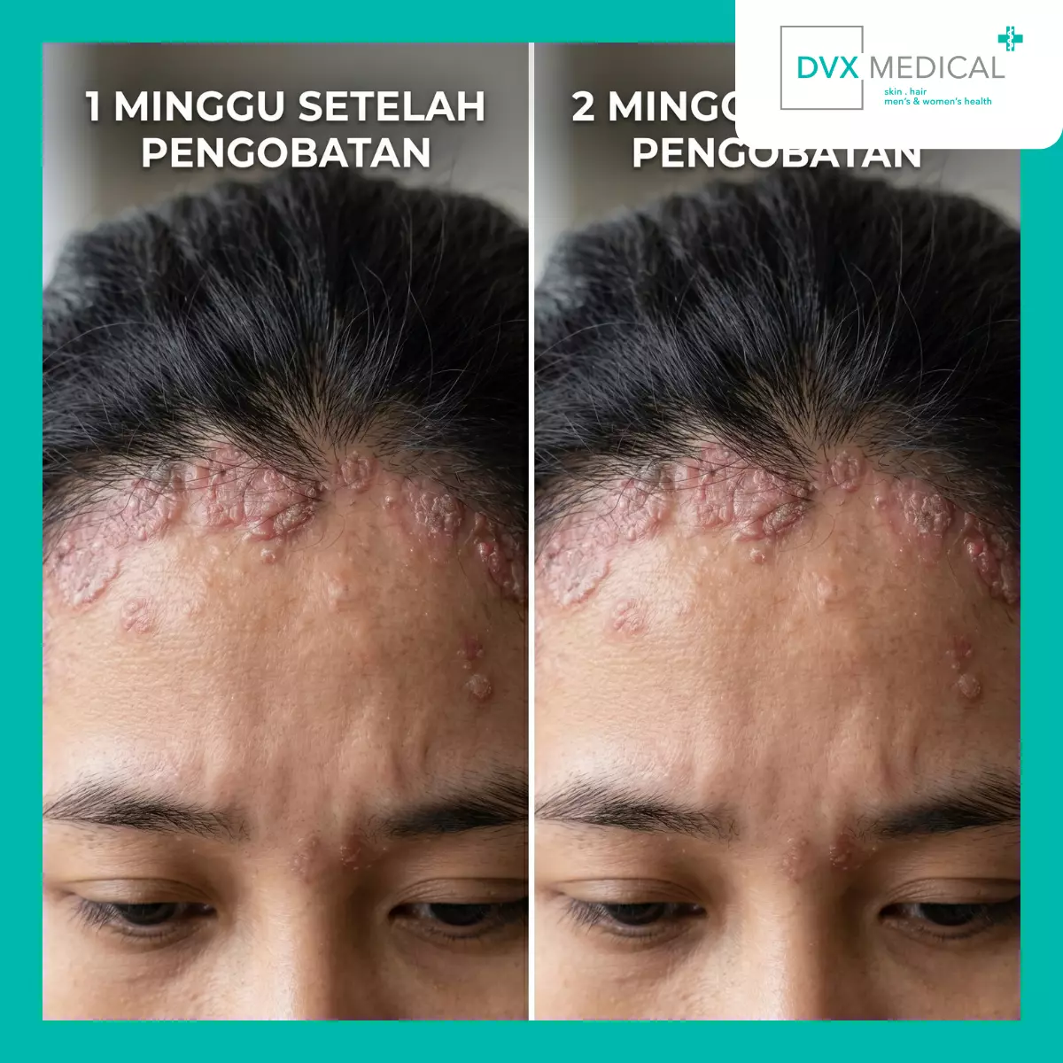 Apakah Tingkat Aktivitas Penyakit Sudah Berubah?