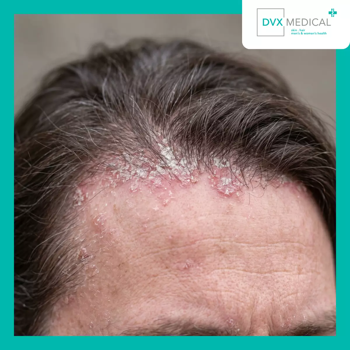 Mengapa Kulit Penderita Psoriasis Terlihat Berbeda?