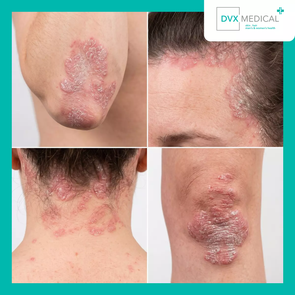 Di Mana Psoriasis Bisa Muncul?