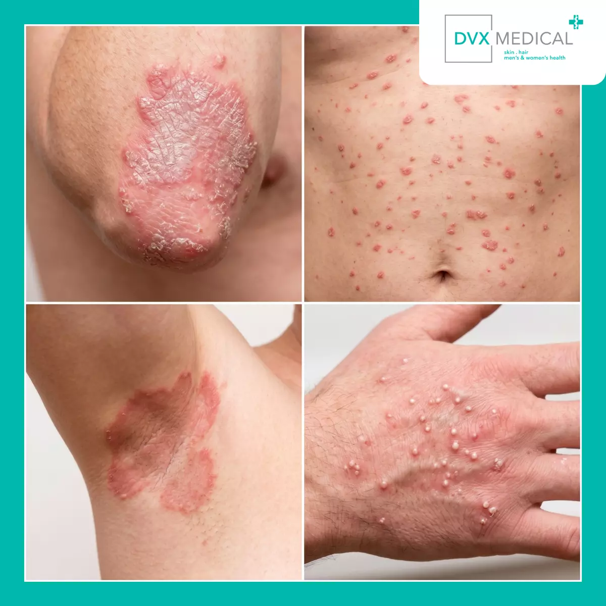 Apa Saja Jenis Psoriasis yang Perlu Diketahui?