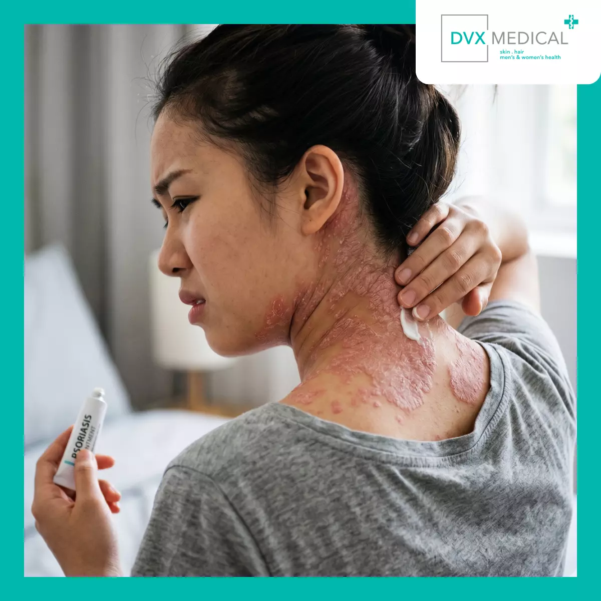 Mengapa Krim Tidak Lagi Praktis untuk Psoriasis yang Lebih Luas?
