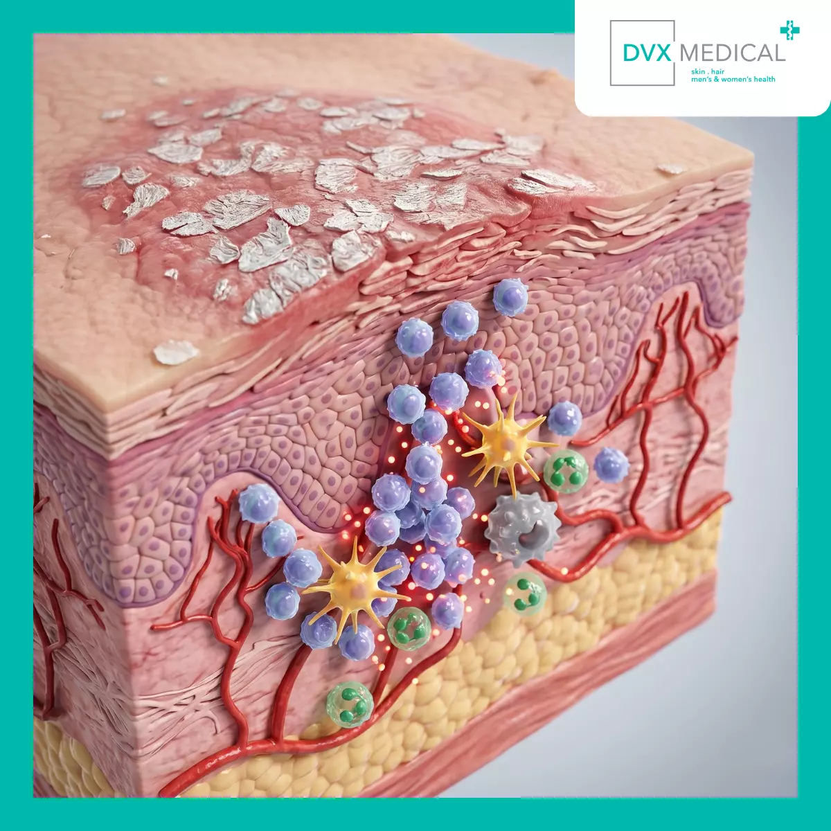 Apakah Sistem Imun Menyerang Kulit pada Psoriasis?