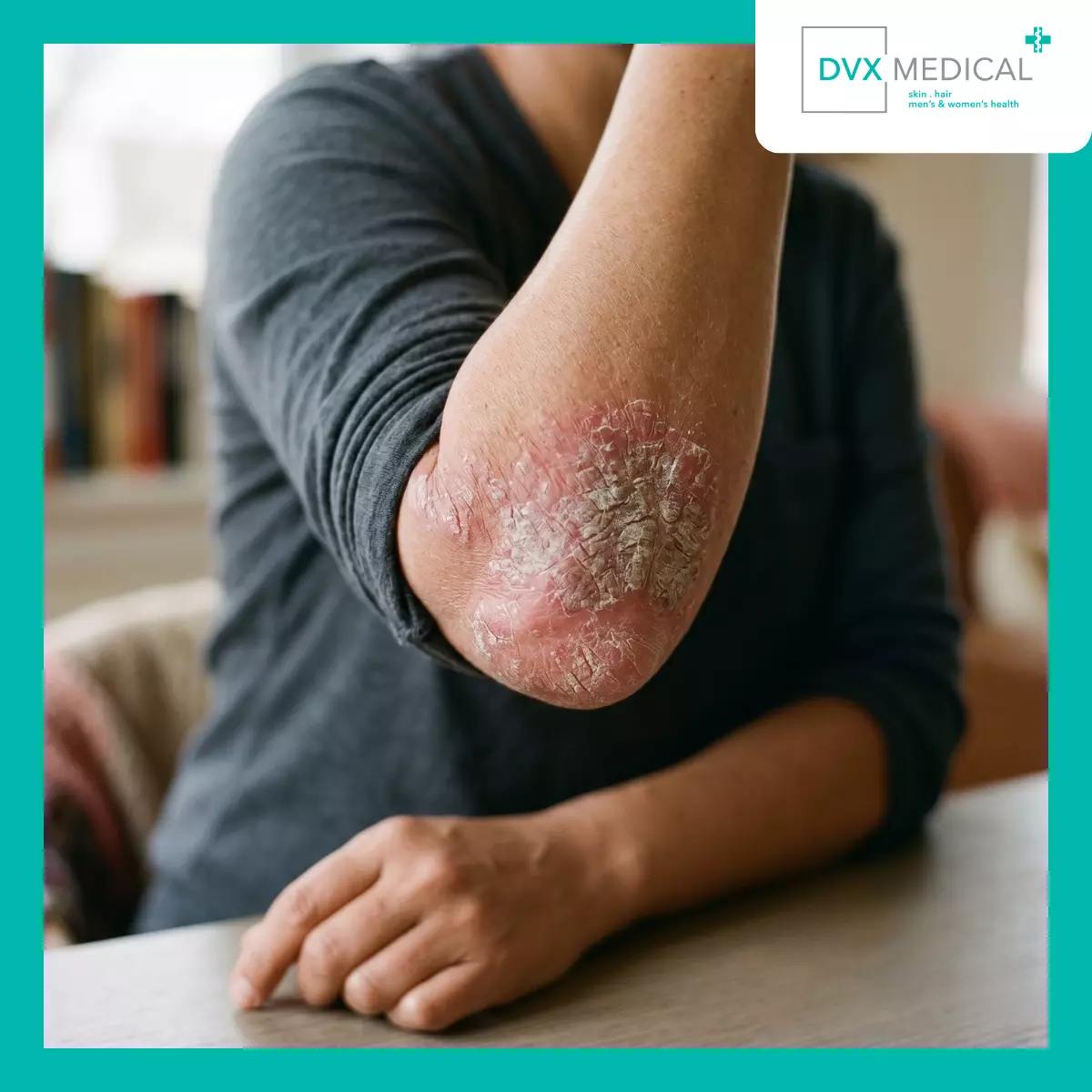 Mengapa Psoriasis Tidak Selalu Berhenti di Kulit?