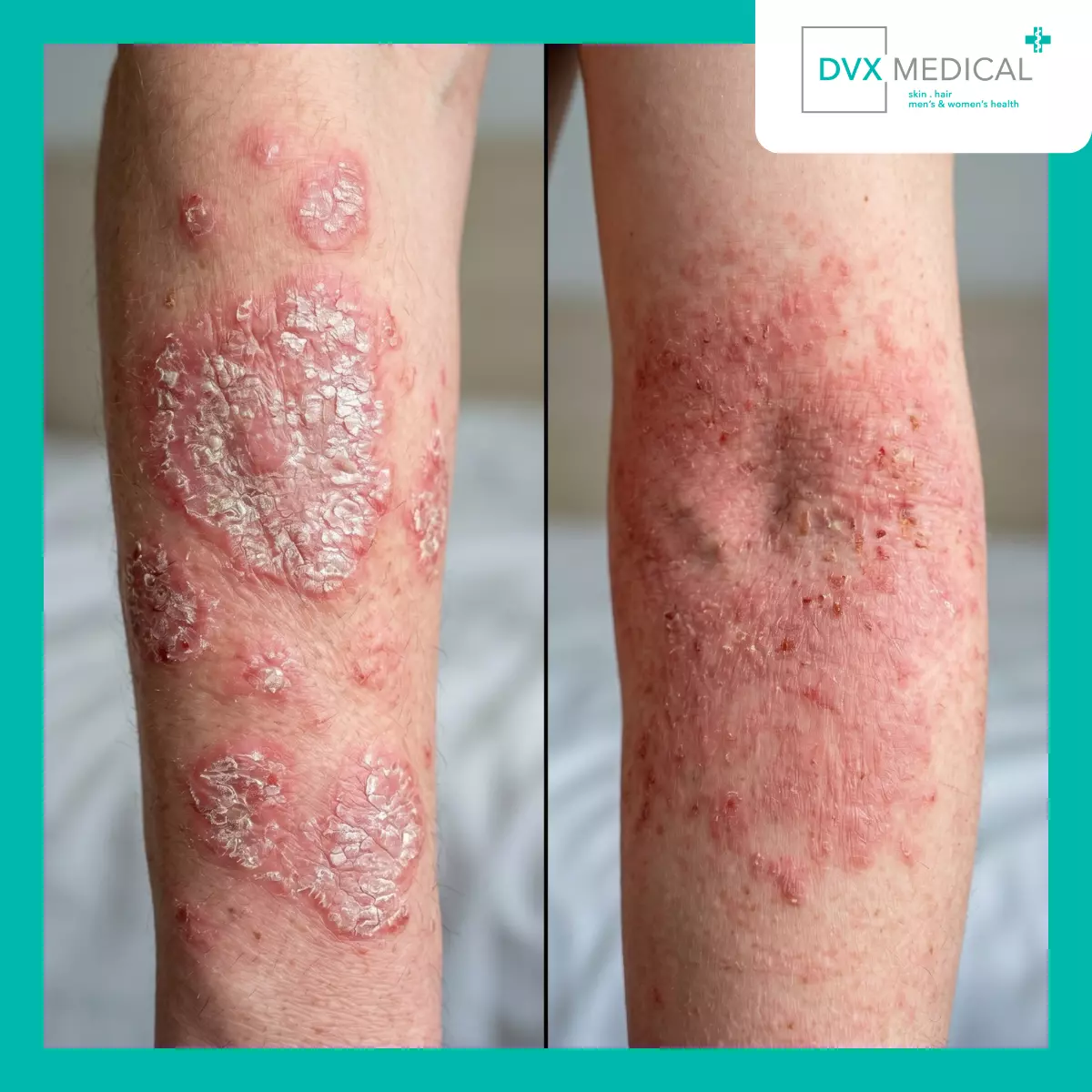 Mengapa Psoriasis dan Dermatitis Atopik Sering Tertukar?
