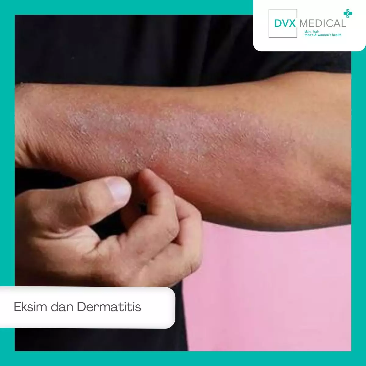 Mengenal Eksim atau Dermatitis Atopik