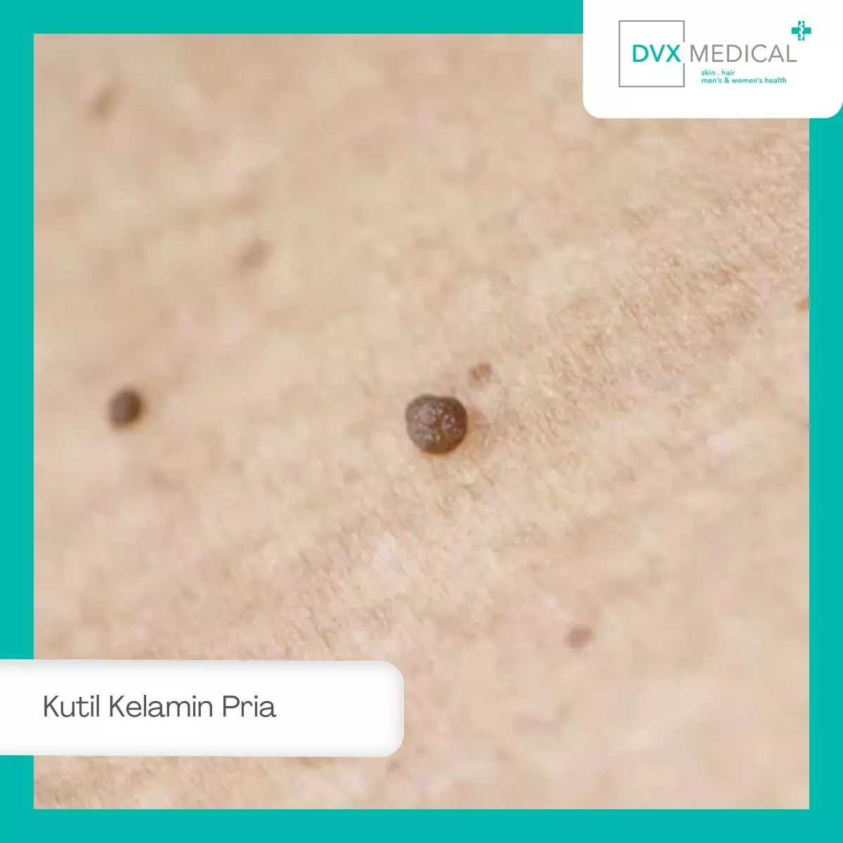 Apa Itu Kutil Kelamin pada Pria?