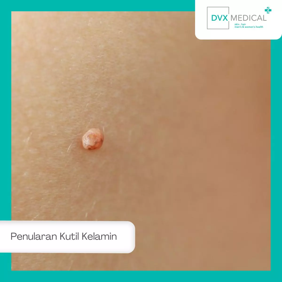 Bagaimana Kutil Kelamin Menular?
