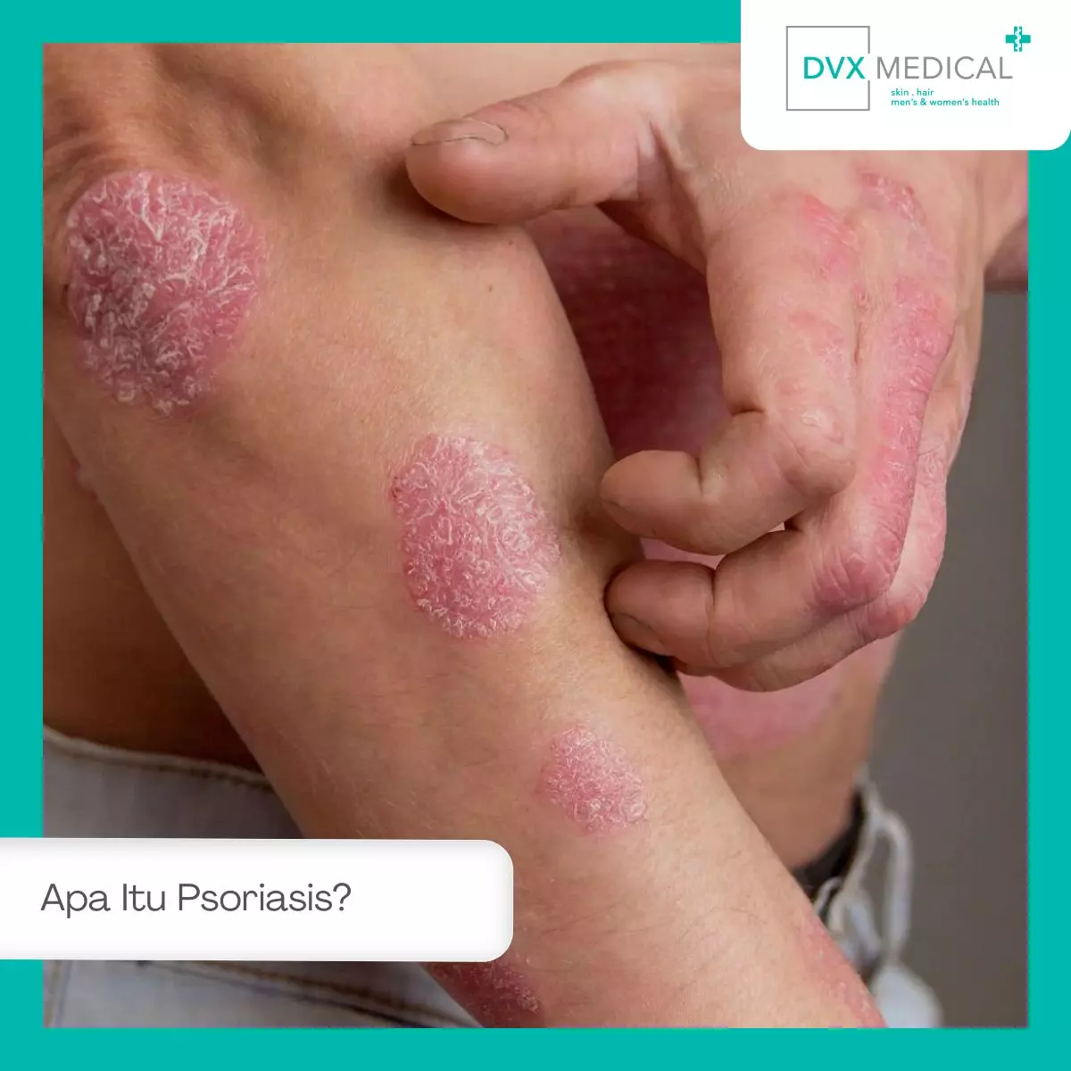 Apa Itu Psoriasis?