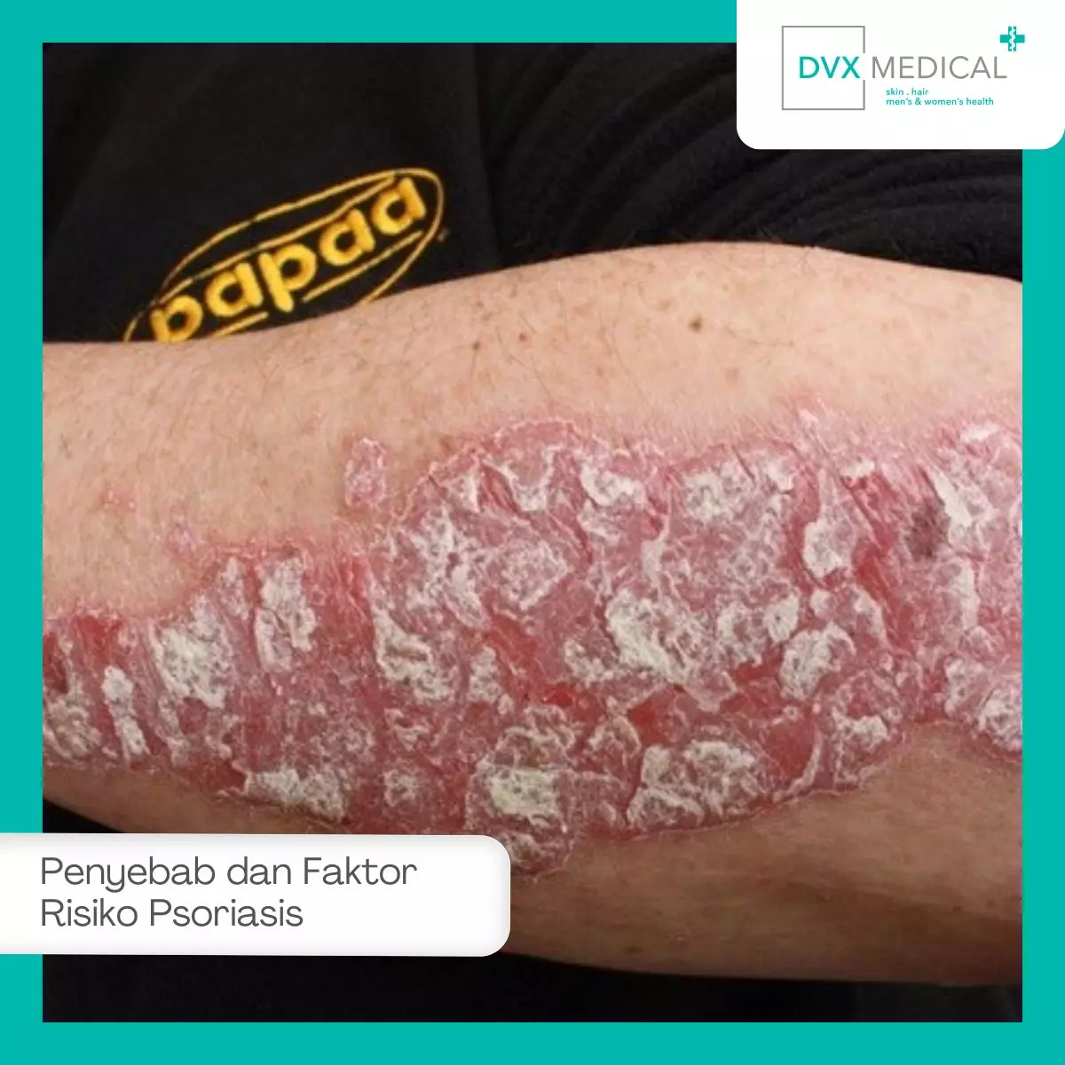 Penyebab dan Faktor Risiko Psoriasis