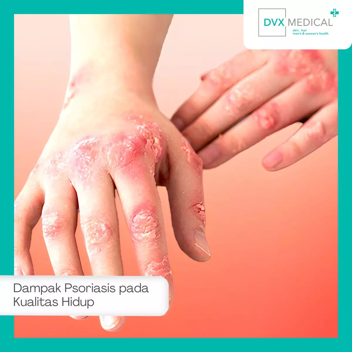 Dampak Psoriasis pada Kualitas Hidup