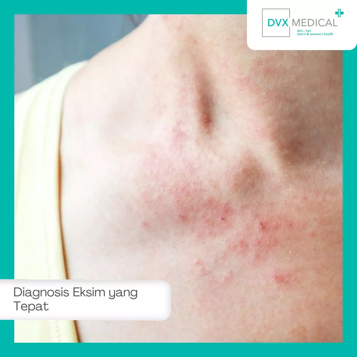 Bagaimana Cara Mendiagnosis Eksim Secara Tepat?