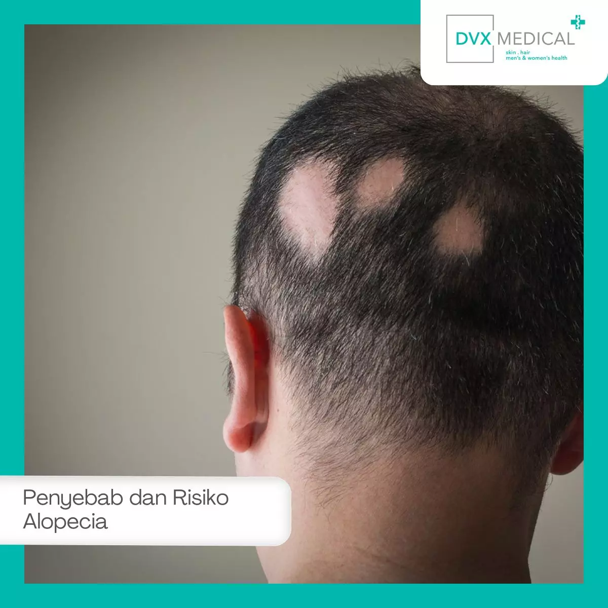 Penyebab Alopecia Areata dan Faktor Risikonya