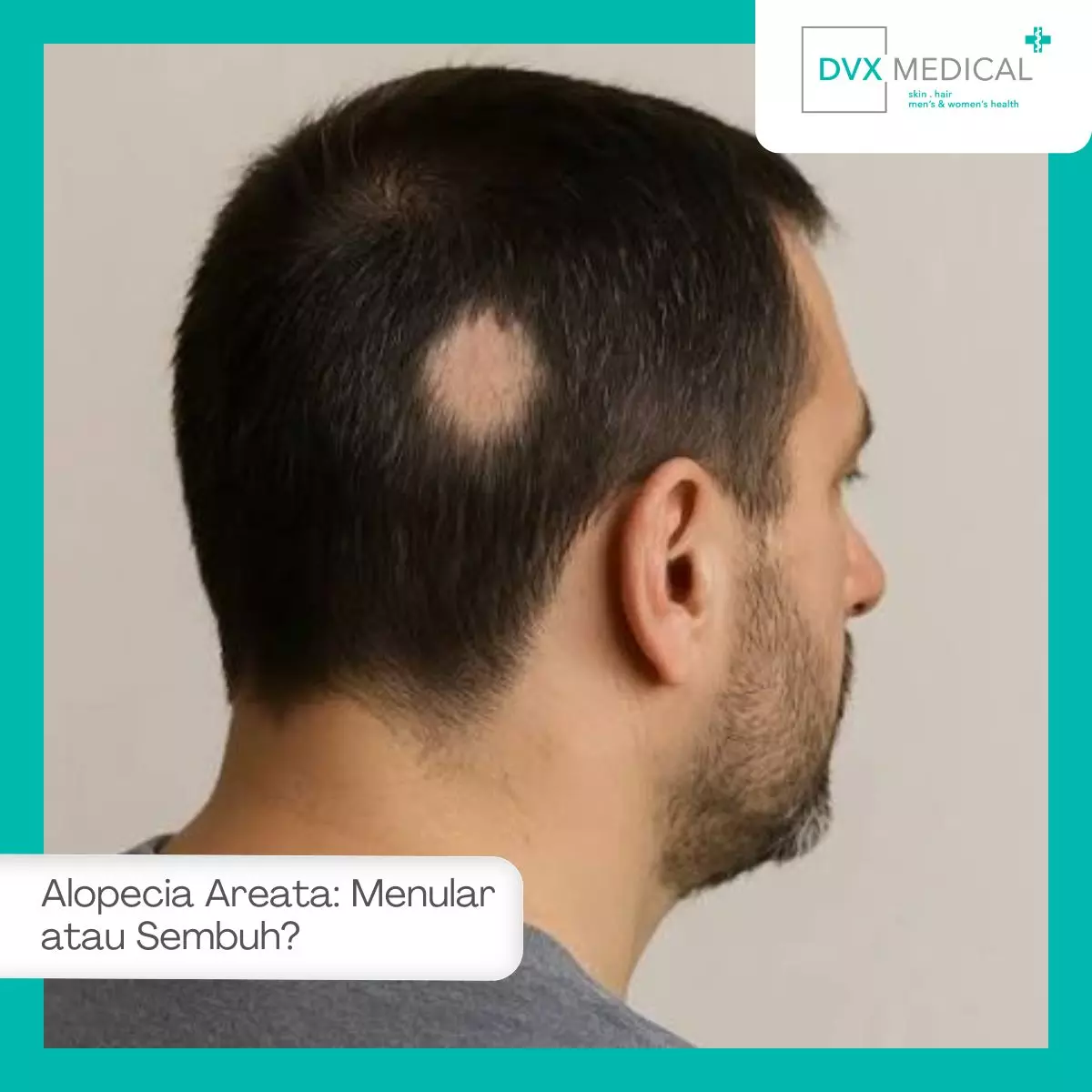 Apakah Alopecia Areata Menular dan Bisa Sembuh?