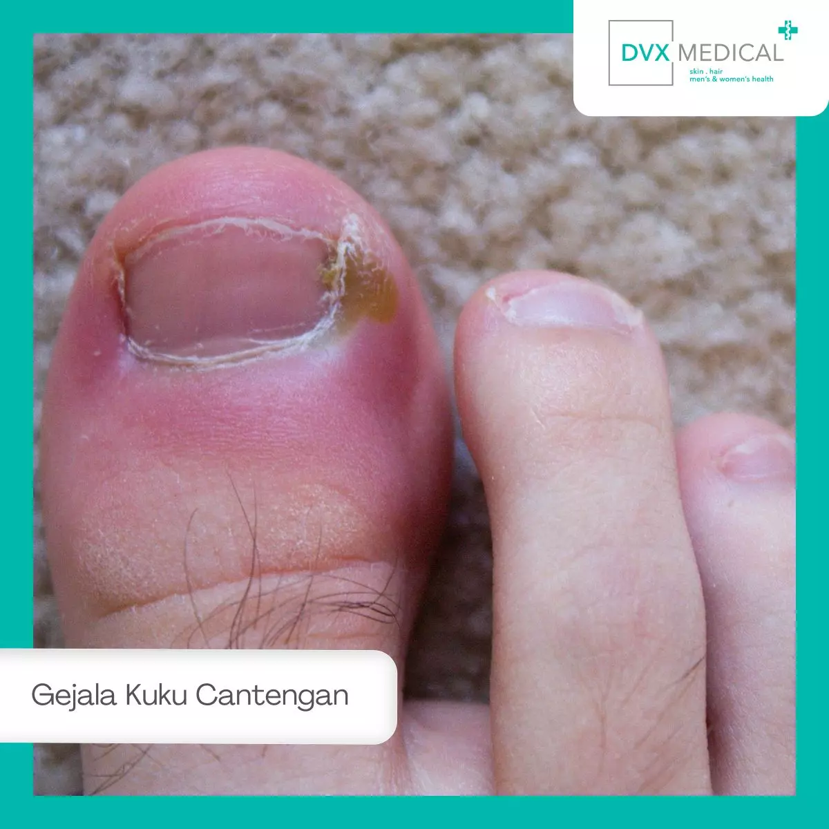 Gejala Kuku Cantengan yang Perlu Diwaspadai