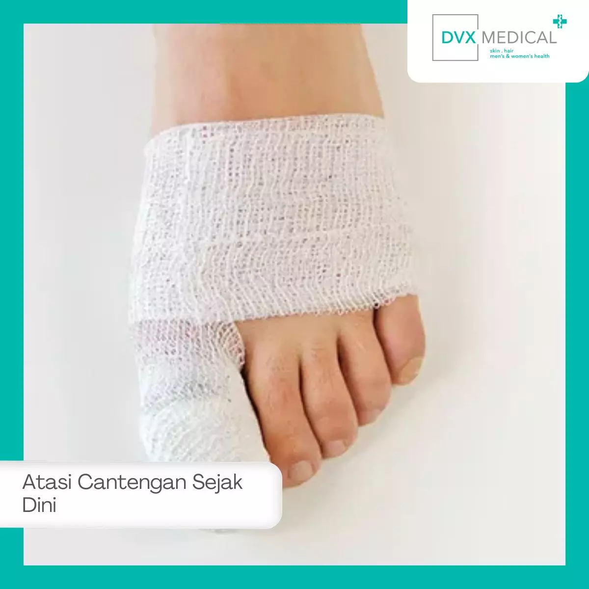 Cara Mengatasi Cantengan Sebelum Menjadi Parah