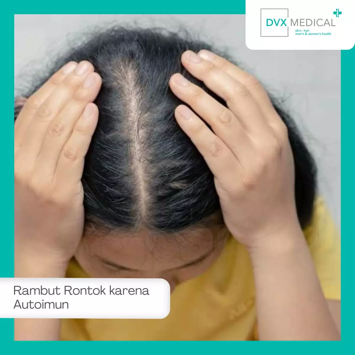 Mengapa Rambut Bisa Rontok Karena Penyakit Autoimun?