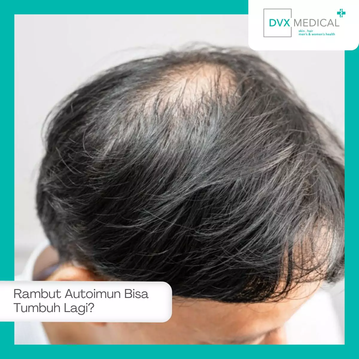 Apakah Rambut Rontok Karena Autoimun Bisa Tumbuh Kembali?
