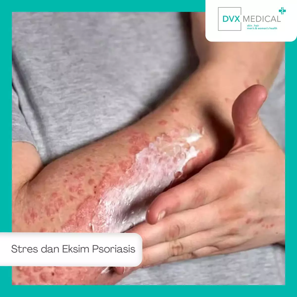Apakah Eksim dan Psoriasis Bisa Dipicu oleh Stres?