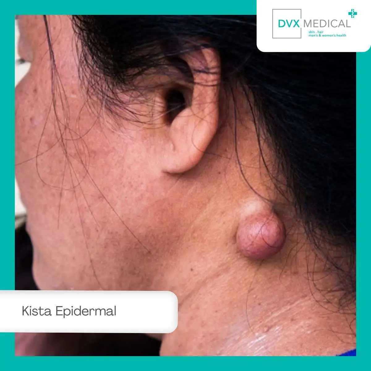 Benjolan di Kulit yang Tidak Hilang, Apakah Kista Epidermal?