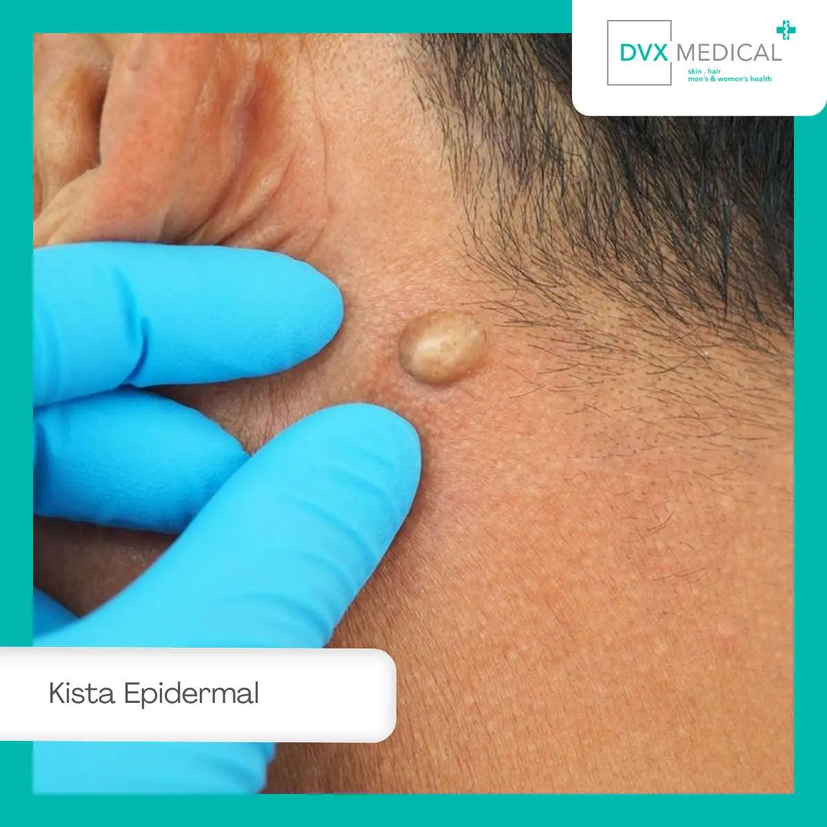 Bedanya Kista Epidermal dengan Jerawat, Bisul, dan Lipoma