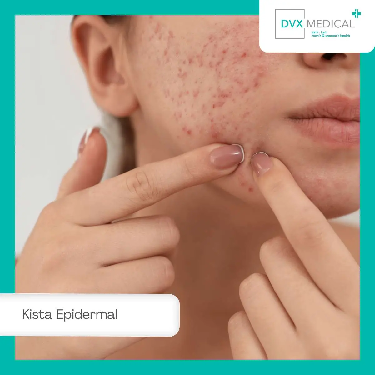 Cara Mencegah Kista Epidermal Muncul Kembali