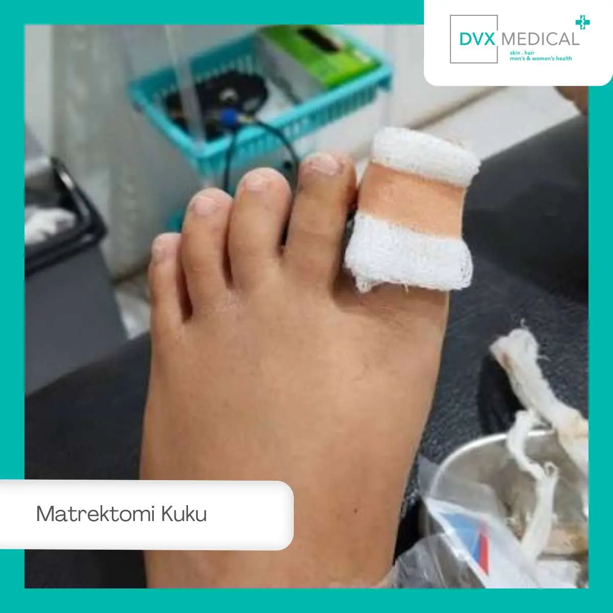 Mengapa Cantengan Bisa Sering Kambuh?