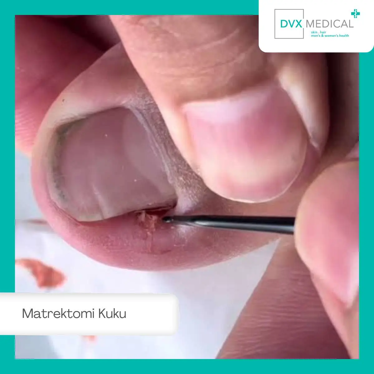 Mengenal Matrektomi Kuku sebagai Solusi Permanen