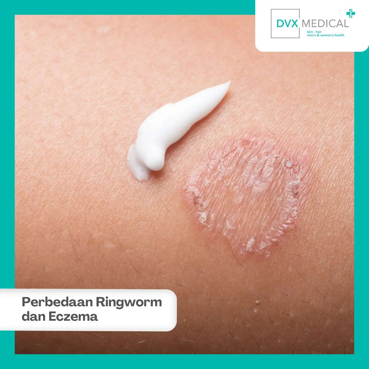 Mengenal Ringworm dan Eksim