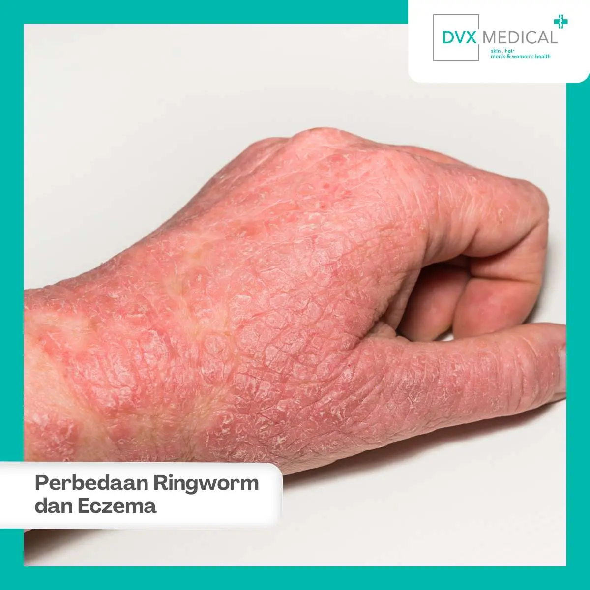 Perbedaan Obat Ringworm dan Eczema