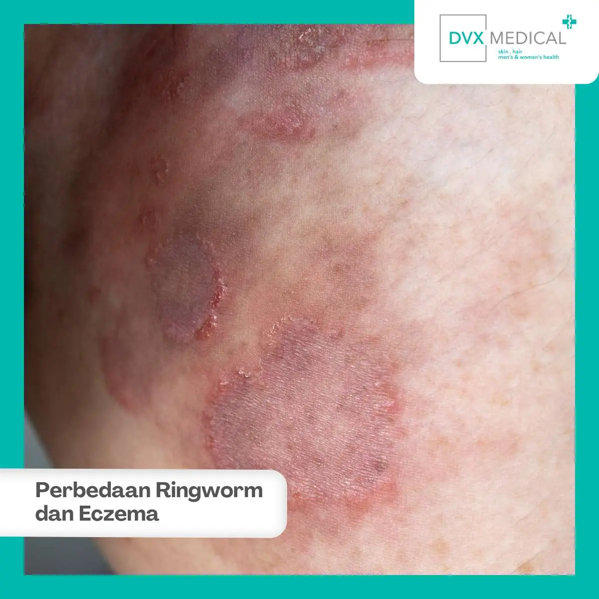 Kenali Perbedaan Ringworm dan Eczema agar Tidak Salah Menggunakan Obat
