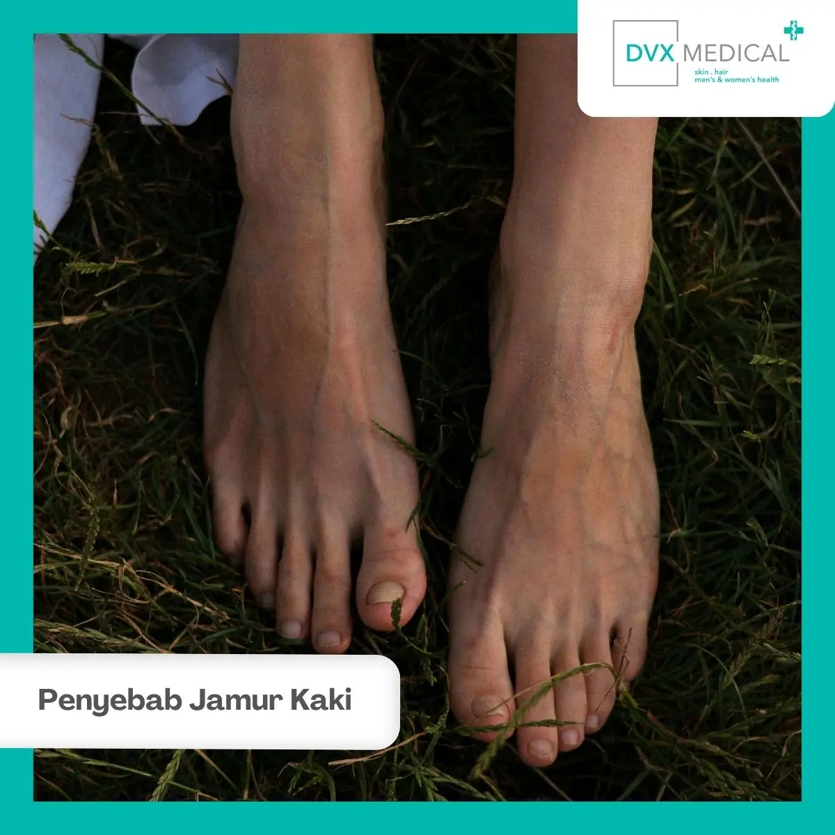 Kenali Gejala Jamur Kaki Sebelum Infeksi Bertambah Luas