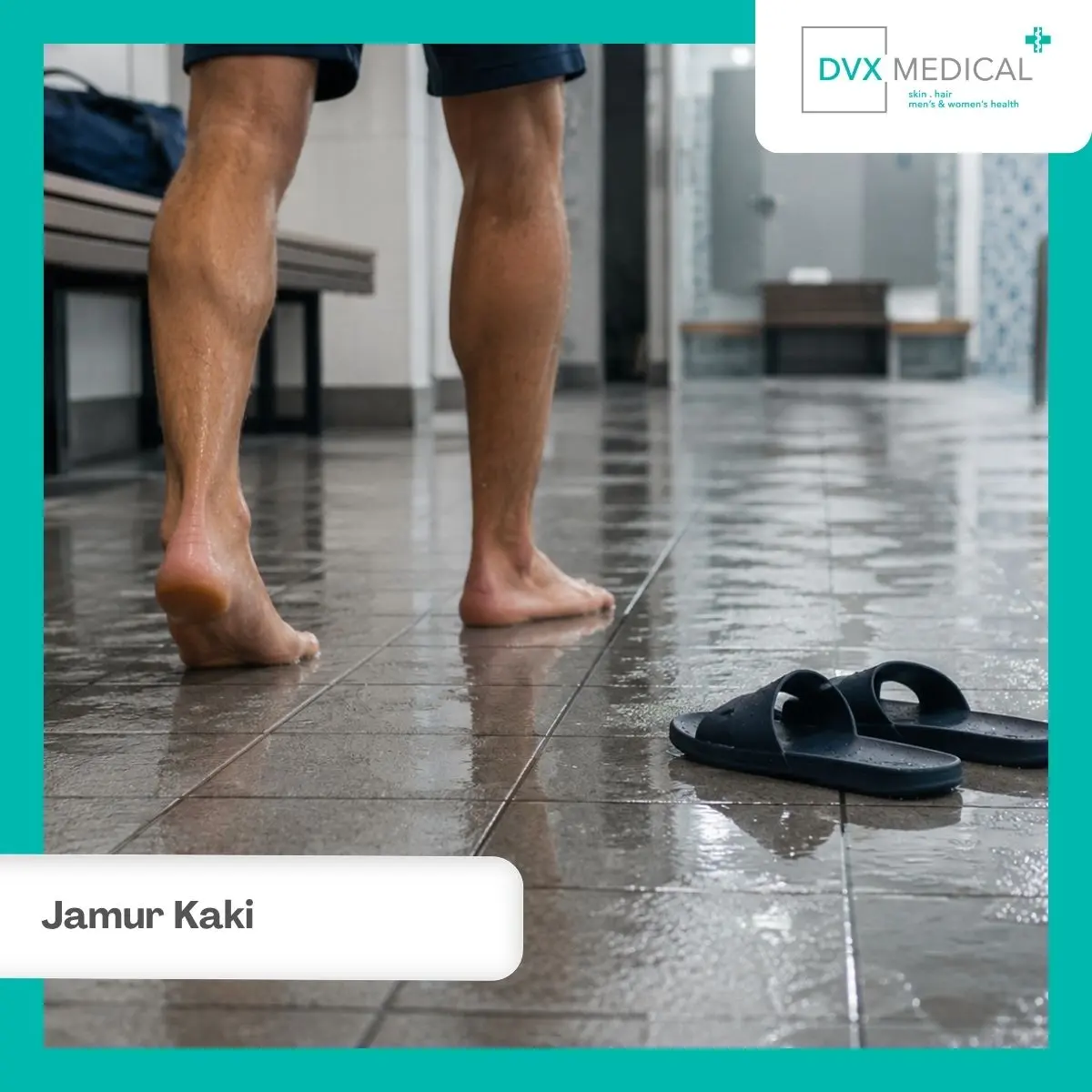 Kenali Gejala Jamur Kaki Sebelum Infeksi Semakin Meluas