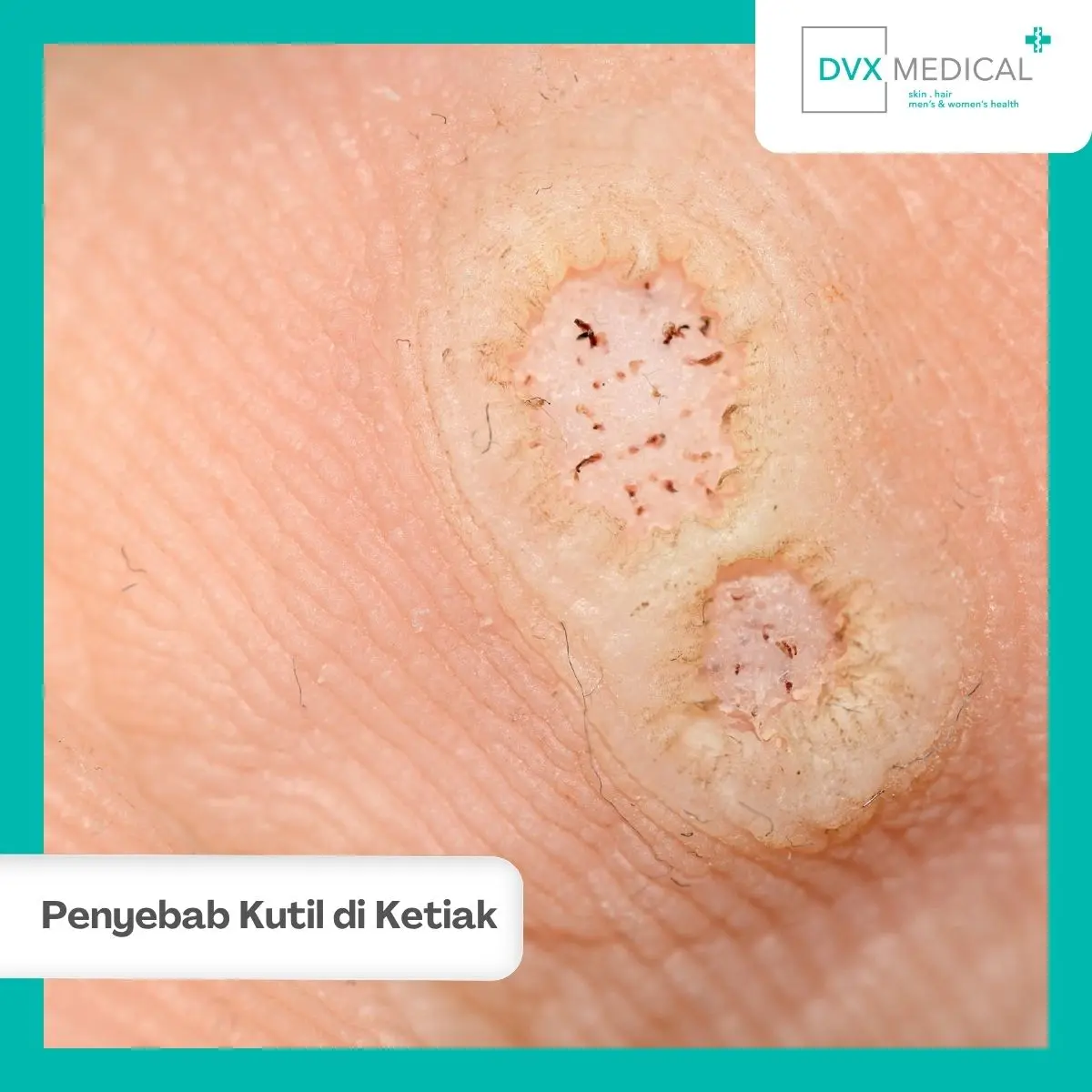 Mengapa Kutil di Ketiak Tidak Boleh Dihilangkan Sendiri?