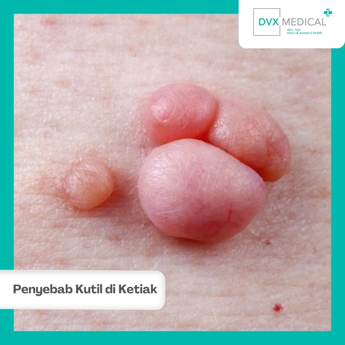 Cara Mencegah Kutil di Ketiak Muncul Kembali
