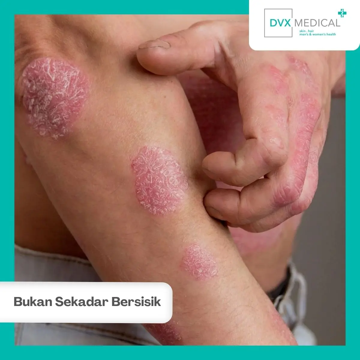 Psoriasis Bukan Sekadar Kulit Kering atau Bersisik