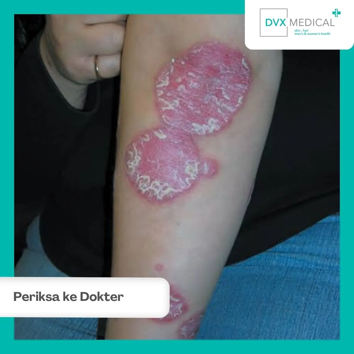 Mengapa Psoriasis Sebaiknya Diperiksa Dokter Spesialis Kulit?