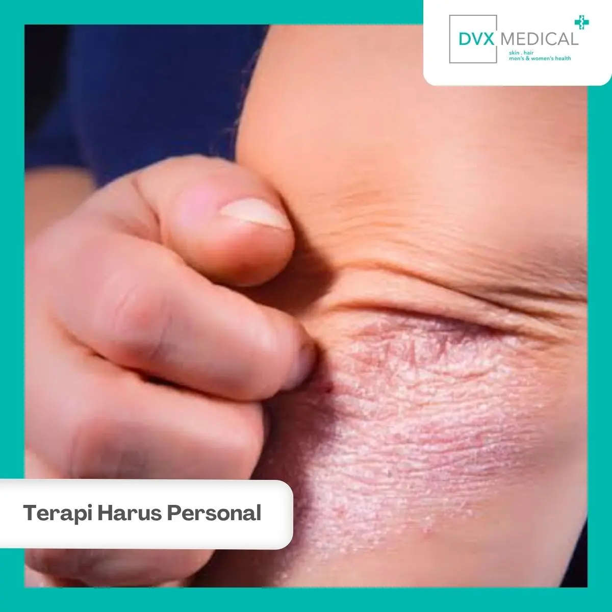 Pilihan Terapi Psoriasis Tidak Sama untuk Setiap Pasien