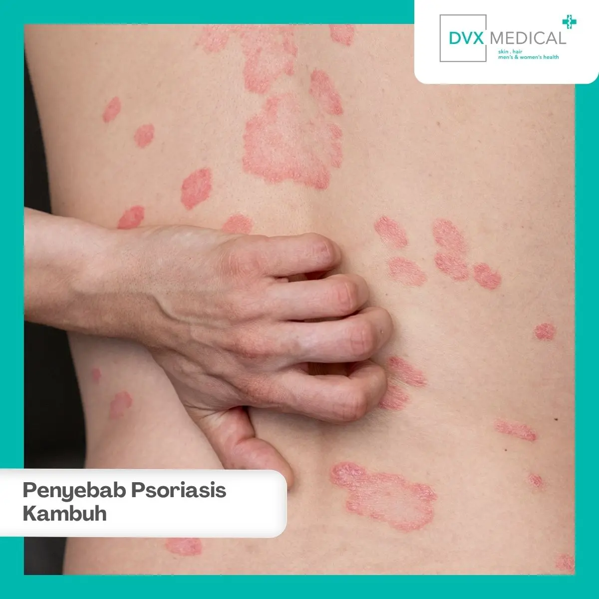 Mengapa Psoriasis Bisa Sering Kambuh?