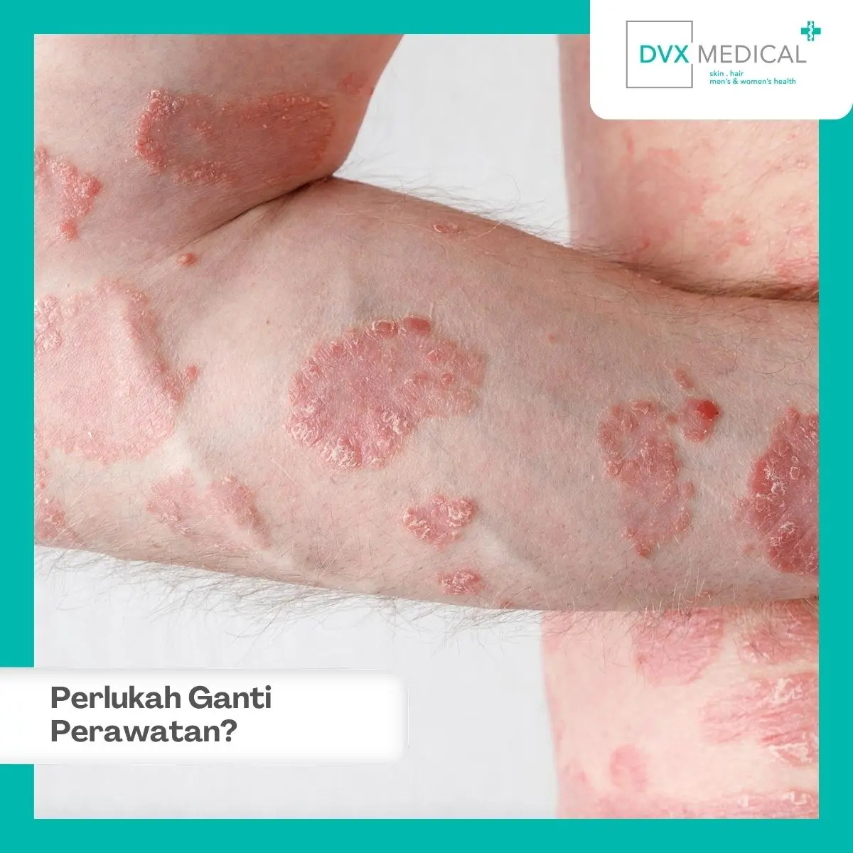 Psoriasis Kambuh, Apakah Perawatannya Harus Diganti?