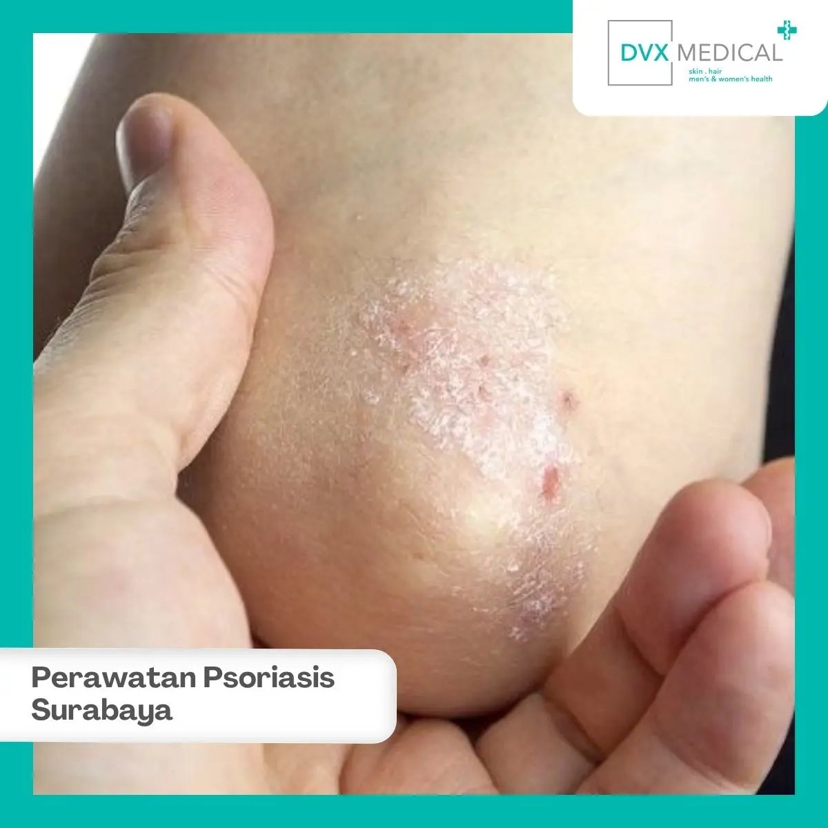 Perawatan Psoriasis di DVX Medical Surabaya