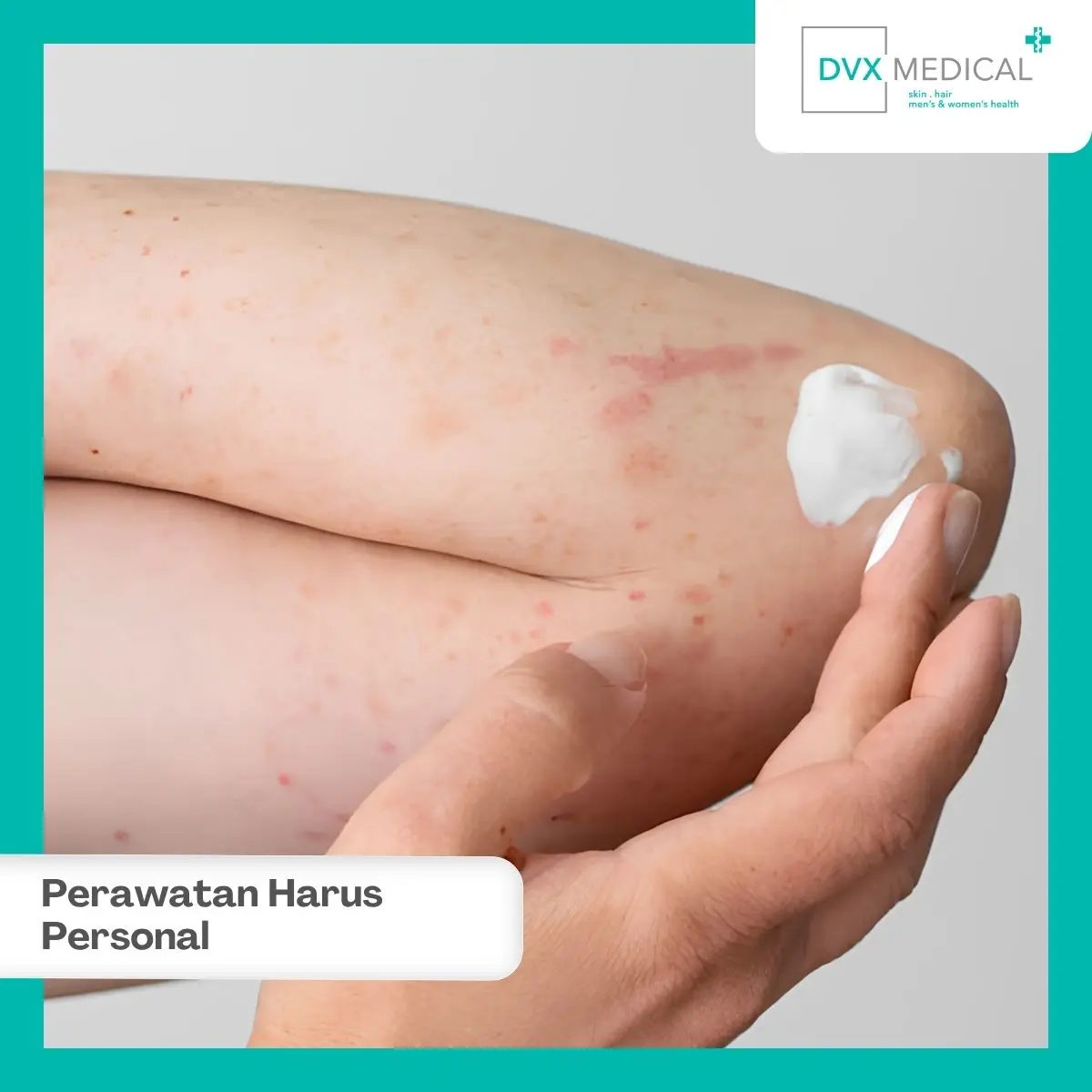 Mengapa Perawatan Dermatitis Atopik Tidak Bisa Disamaratakan?